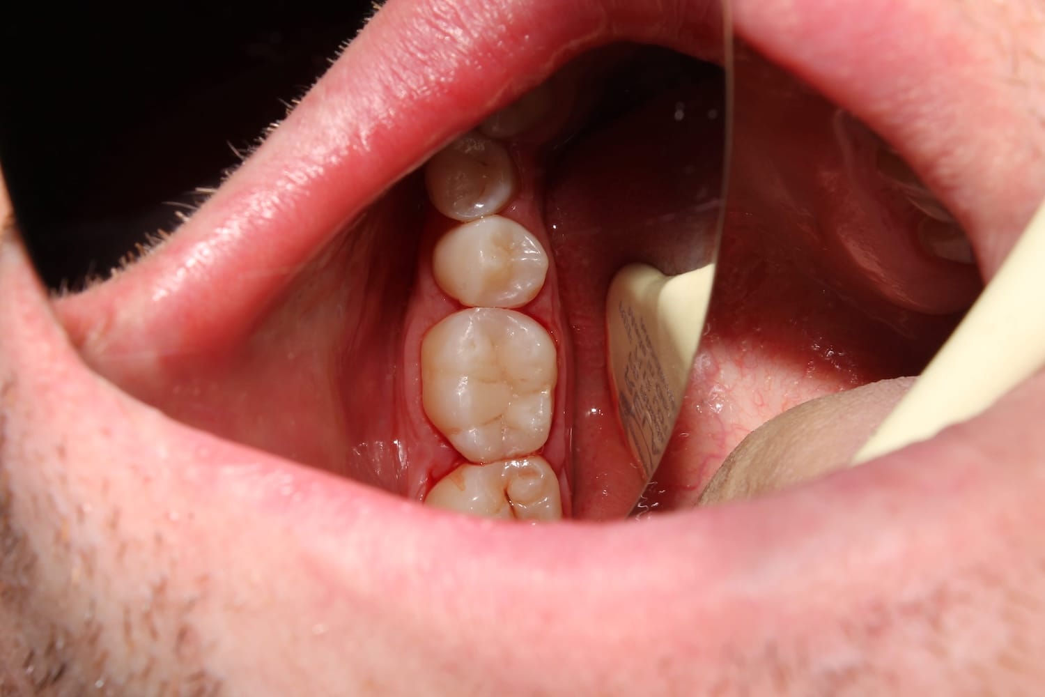 Hipercementosis dental raices dientes